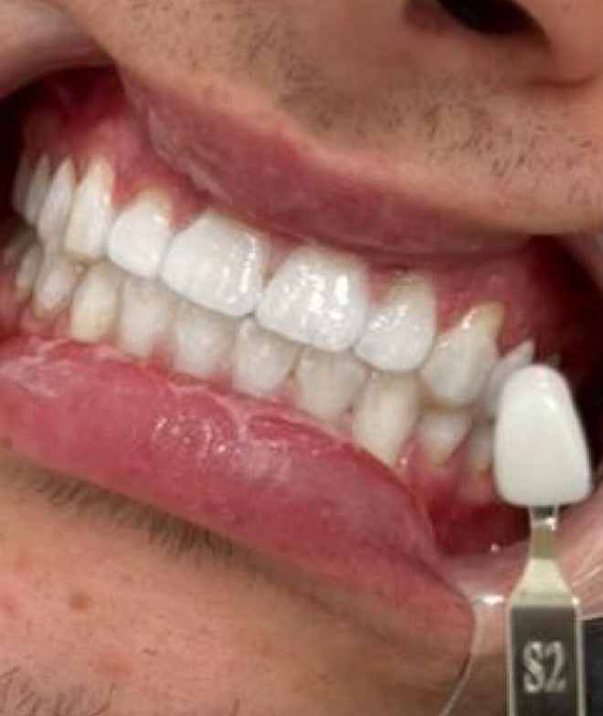 A brighter-looking smile after UV light teeth whitening at Brid's