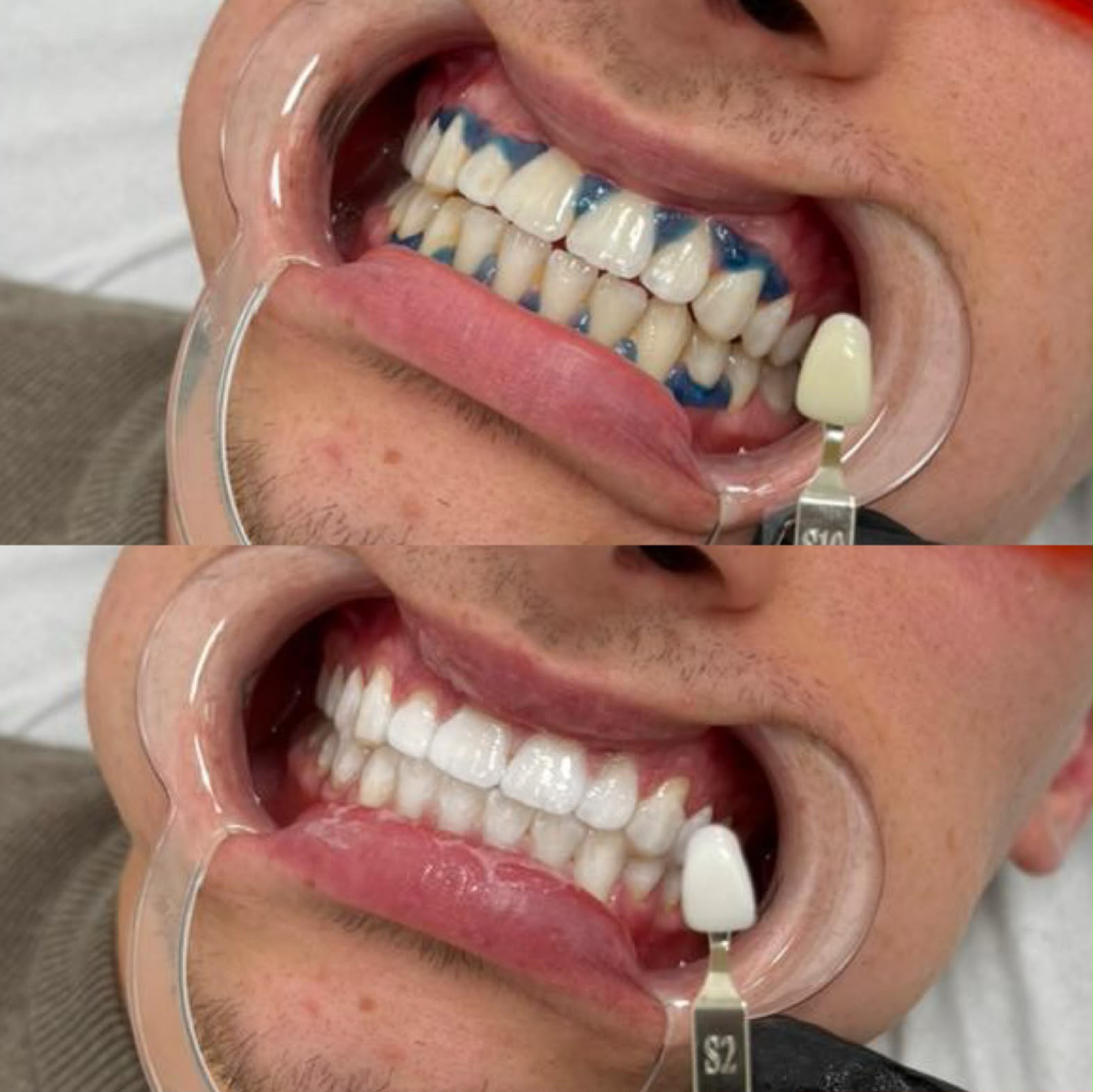 Teeth whitening before and after at Brid's Tanning & Beauty - before with the gum barrier and shade guide, after whiter